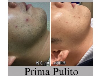プリマプリート メンズ店の写真/VIO・ボディ・ヒゲまで！気になる部分を気になる時に通える都度払いで美肌ケア◎