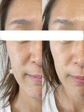 メディカルエース(MedicalAce)/マイクロニードルピーリング