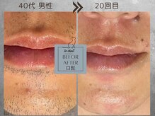 ル シャ/メンズ脱毛/毛穴洗浄/ヘッドスパ