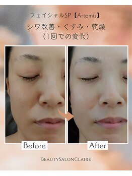 クレール(Claire)/【フェイシャルSP】目元シワ改善