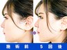 【挙式1ヶ月前駆け込み～見た目激変☆】ブライダルエステ鍼灸整体 90分/27000
