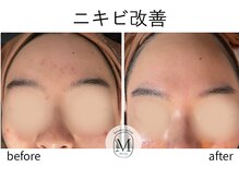 ミヨン(Miyong)/ニキビ改善　
