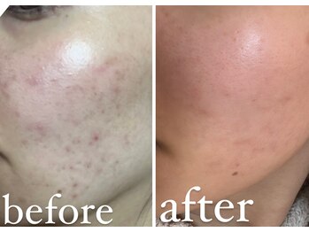 クラスペディア 嘉島店/ララピール/ララ美肌鎮静パック