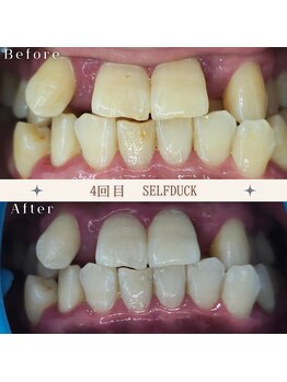 セルフダック 京都長岡京店/◇ホワイトニングの症例写真8