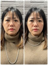 長寿鍼灸院 長寿整骨院/美容鍼50本の効果★小顔効果