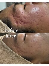 オーシャンハーブ(Ocean Harb)/【メンズのニキビケアに特化】