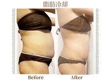 モテスリム/脂肪冷却 お腹2カップ