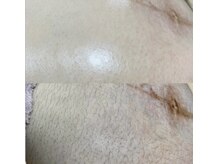 ミーミドットアイ(Mi-mi.i)/マタニティワックス脱毛