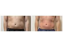 ナッツ(Nuts)/上半身コース