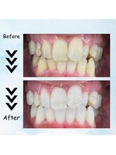 エクシアホワイトニング 塩釜口駅前店/２０代後半の男性の効果事例