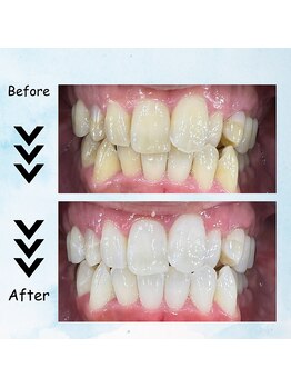 エクシアホワイトニング 塩釜口駅前店/20代後半の男性の効果事例