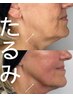 【新MENU導入】究極の小顔×たるみケア★アマンスリフト¥33,000→¥16,500 
