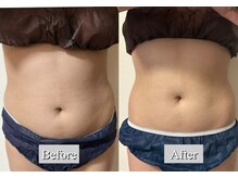 オレンジ(Orange)/2部位/痩身マシンBefore After