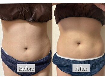 オレンジ(Orange)/2部位/痩身マシンBefore After