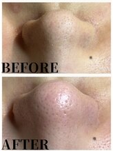 エミルカ 自由が丘店(EMILUCA)/毛穴エクストラクション