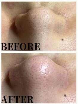 エミルカ 自由が丘店(EMILUCA)/毛穴エクストラクション