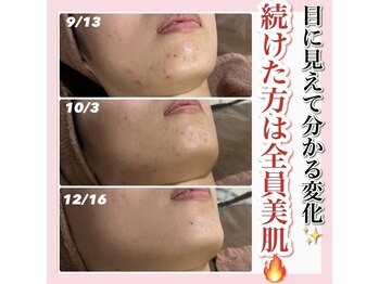 ホワイトアクア 天王寺本店(WHITE AQUA)/ハーブピーリング/大阪/天王寺