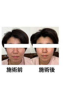 さっぽろ心灯はり・きゅう院/たるみ・肌質↑美容鍼