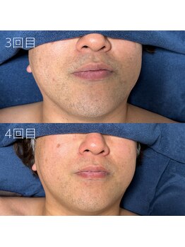 カナウ(KANAU)/ヒゲ脱毛（40代前半男性）