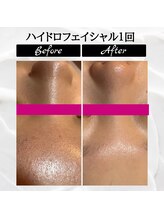 ポムポムボナー/ハイドロフェイシャル毛穴洗浄♪