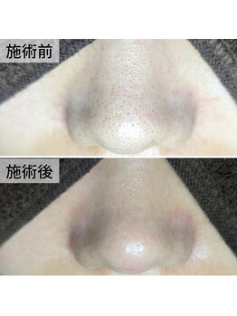 美鼻ラボ 押上 曳舟/毛穴の黒ずみでご来店のお客様