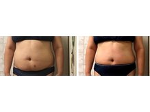 ピーキュア/３回のビフォーアフター