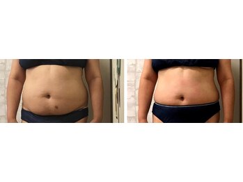 ピーキュア/3回のビフォーアフター