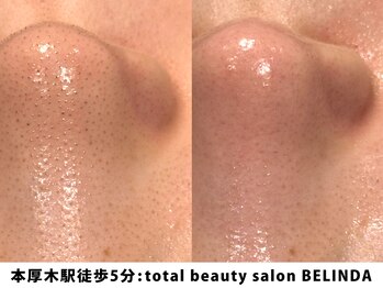 ベリンダ(BELINDA)/毛穴洗浄ハイドロスプラッシュ