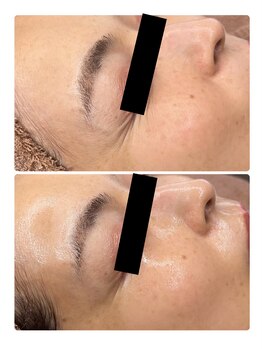 エクラルム(Eclaleum)/BeforeAfter　ララピール