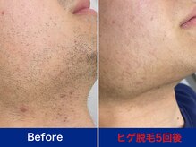 ミスターアンクール 鹿児島(Mr.uncoeur)/ヒゲ脱毛5回後