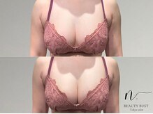 エヌドット 日本橋(N.)/下垂を上げるバストアップ