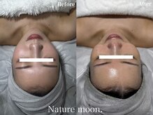 ナチュールムーン(Nature moon.)/ハーブピーリング