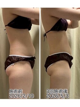 クールスパ(COOL SPA)/20代女性お腹症例
