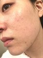 ハミングスキン(Humming skin)&nbsp;ハーブピーリングに出会う前の私の肌。敏感肌に悩んでいました。