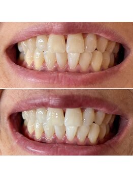 アンベリール(Embellir)/美容セルフホワイトニング