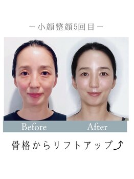 マナレア(Manalea)/リフトと小顔が両方叶う！