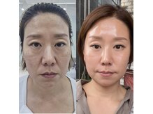 【インセルダム導入】エイジング特別プログラム12日韓国→日本に