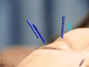 ビハダ(BIHADA)/国産最高級の鍼を使用！