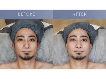 カズキハギワラ(Kazuki Hagiwara)/ビオフィート施術当日ビフォアフ