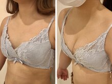 リール 恵比寿店(RIRE)/バストアップ症例【広尾恵比寿】