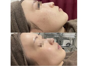 ニキビケア研究所 所沢店/憧れの陶器肌