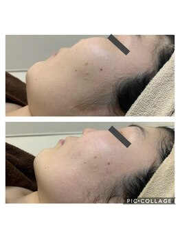 サロンドココ(Salon de COCO)/小顔/ハイパーナイフ