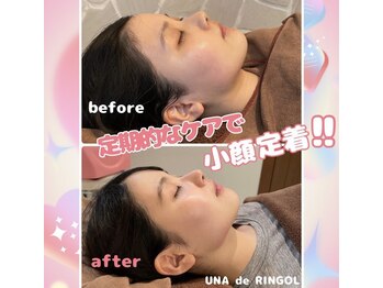 ウナ デ リンゴル 恵比寿店(UNA de Ringol)/定期的なケアで小顔定着♪