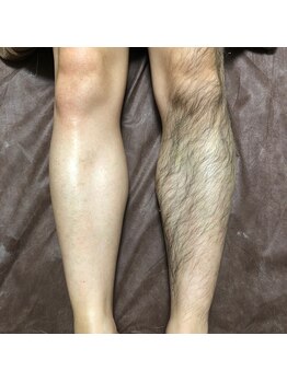 ハレノヒ(HaLeNoHi)/【ブラジリアンワックス】