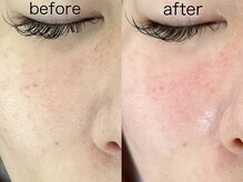 アトレ アンド ミューズ(Attrait×Muse)/【たるみ毛穴改善!!】