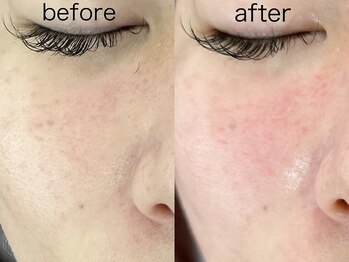 アトレ アンド ミューズ(Attrait×Muse)/【たるみ毛穴改善!!】