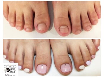 トイロ(toiro)/フットの深爪矯正