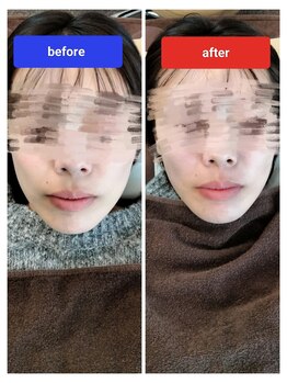 ユープラス(YOU PLUS)/美容鍼before/after