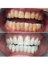 アンベリール(Embellir)/医療提携ホワイトニング