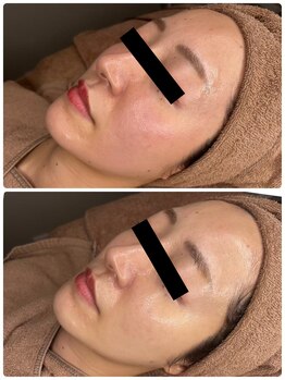 エクラルム(Eclaleum)/BeforeAfter　ララピール